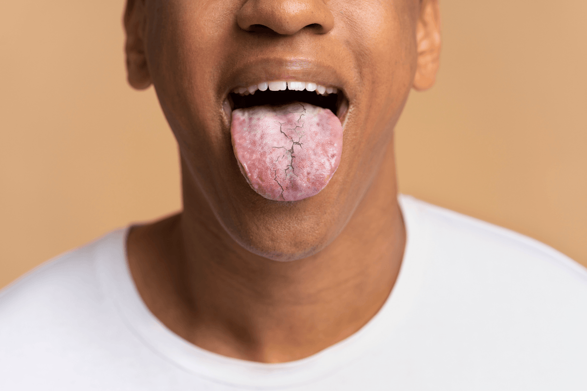 Why Mouth Breathing Causes Dry Mouth and How to Fix It – Solid8 Sleep